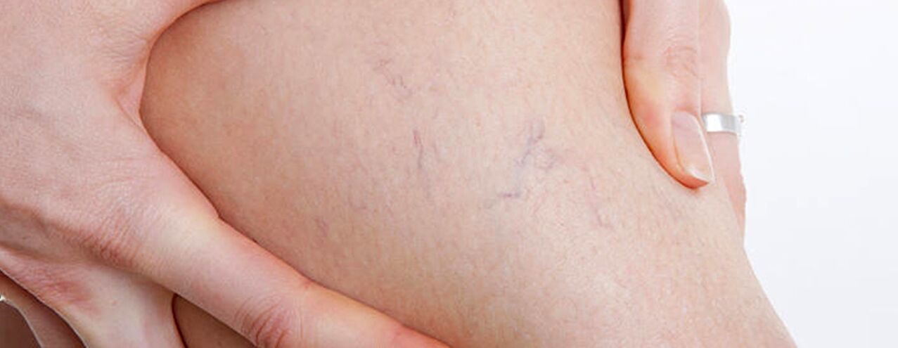 how do varicose veins